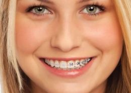 Son los brackets solo una cuestión de estética?