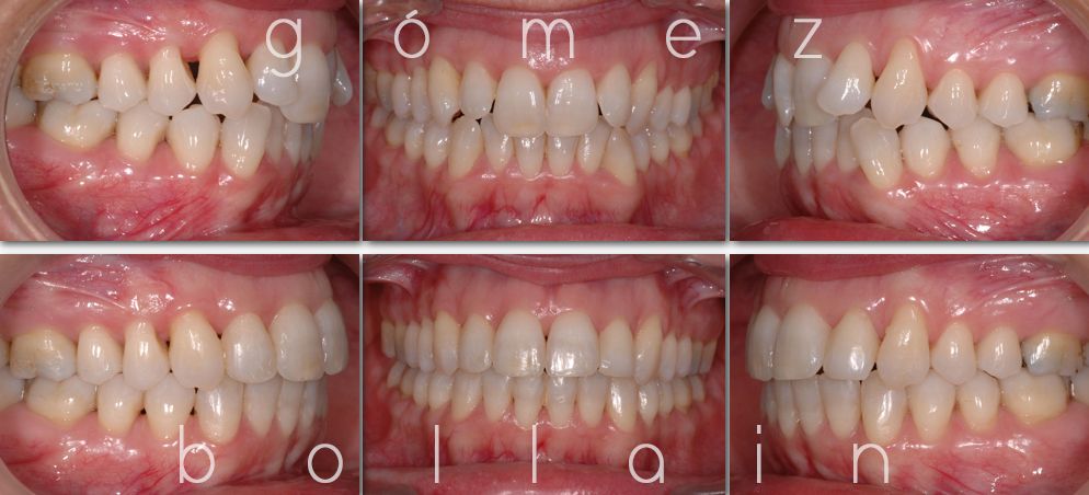 aparato-dental-invisible-en-bilbao