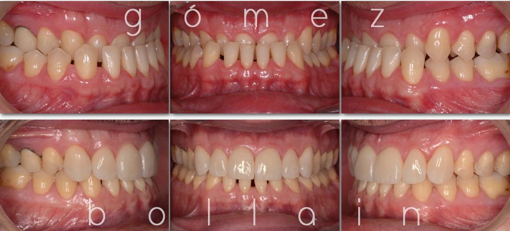 brackets-en-adultos-bilbao brackets-en-adultos-bilbao