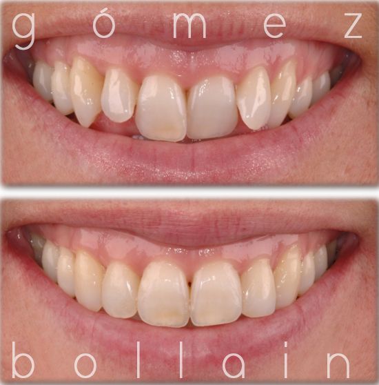 invisalign-en-bilbao invisalign-en-bilbao
